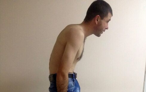 Ankylosing spondylitis can cause lower back pain for years