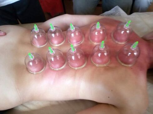 Vacuum cupping is an excellent way to treat low back pain at home