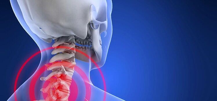 Osteochondrosis of the cervical vertebrae