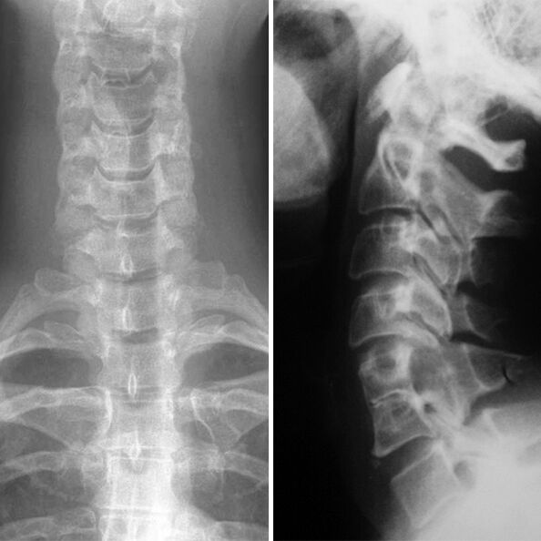 X-ray of the cervical vertebrae